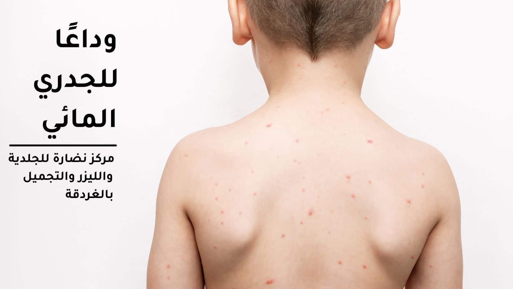 وداعًا للجدري المائي